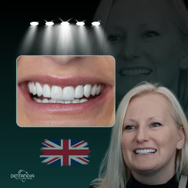 Smile transformation result of a female patient at Dentaneva